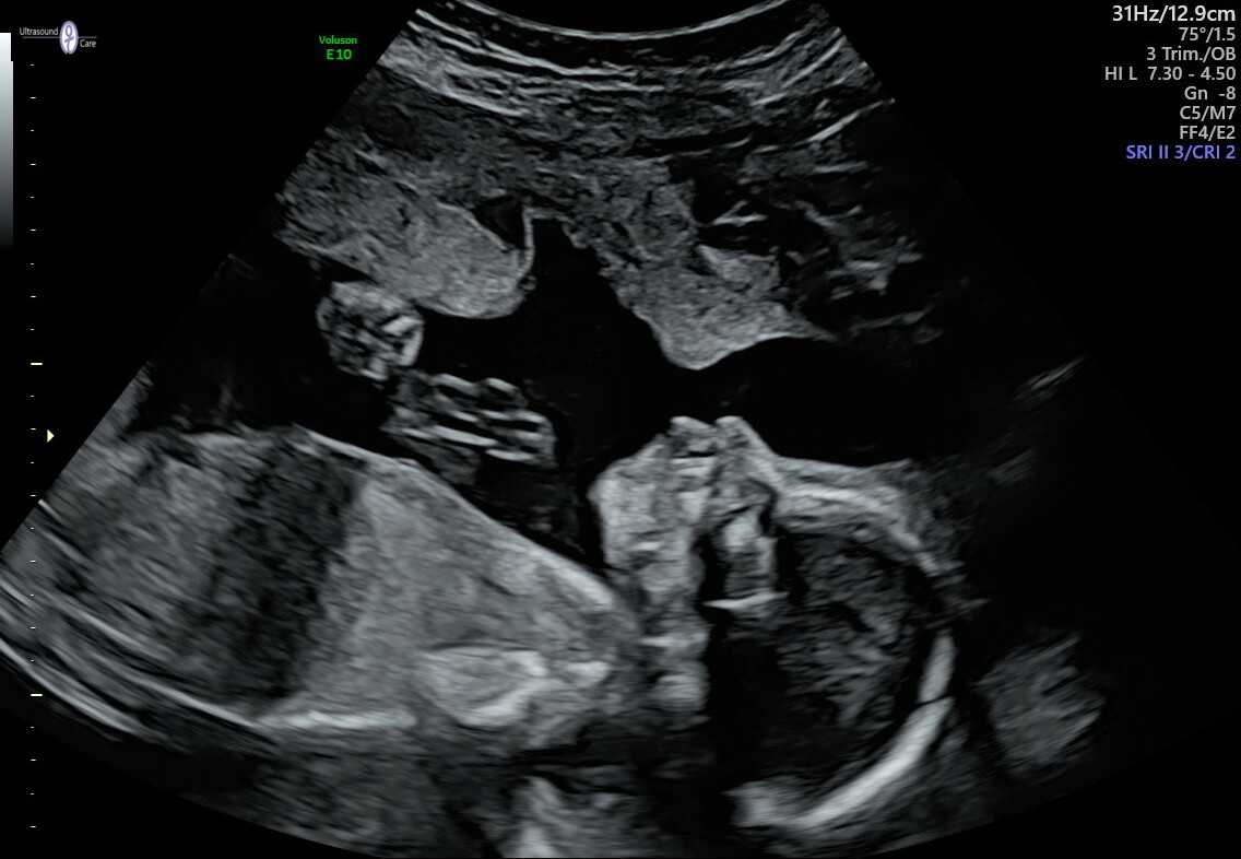 A 20 week ultrasound image of baby number 2.